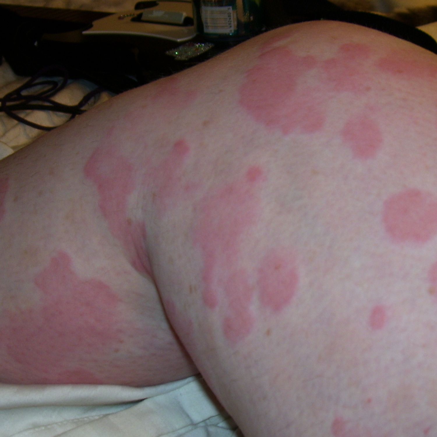 itchy skin hives
