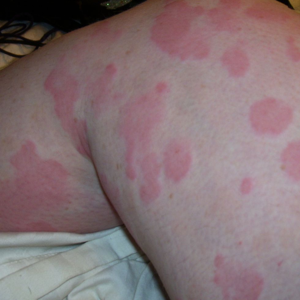 hives urticaria identification picture