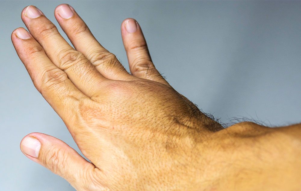6 Rheumatoid Arthritis (RA) Symptoms & Signs