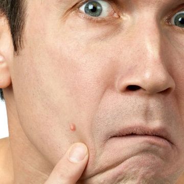 man looking at zit on his face