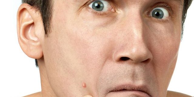 5 Reasons You Might Have Adult Acne  