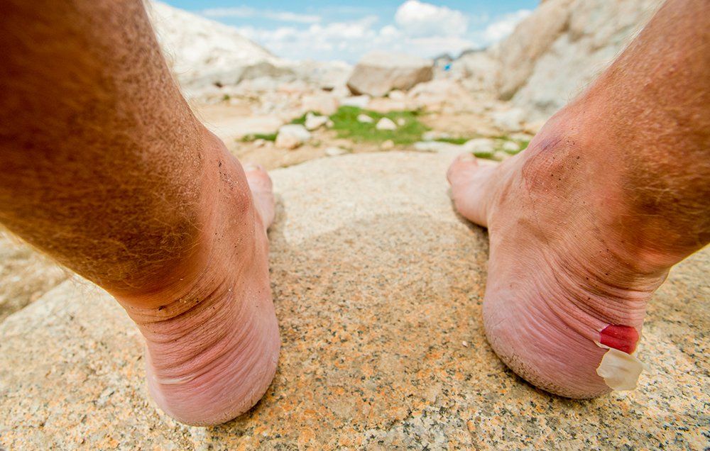 Weiland Slager Luidruchtig The Fastest Way To Heal a Blister | Men's Health