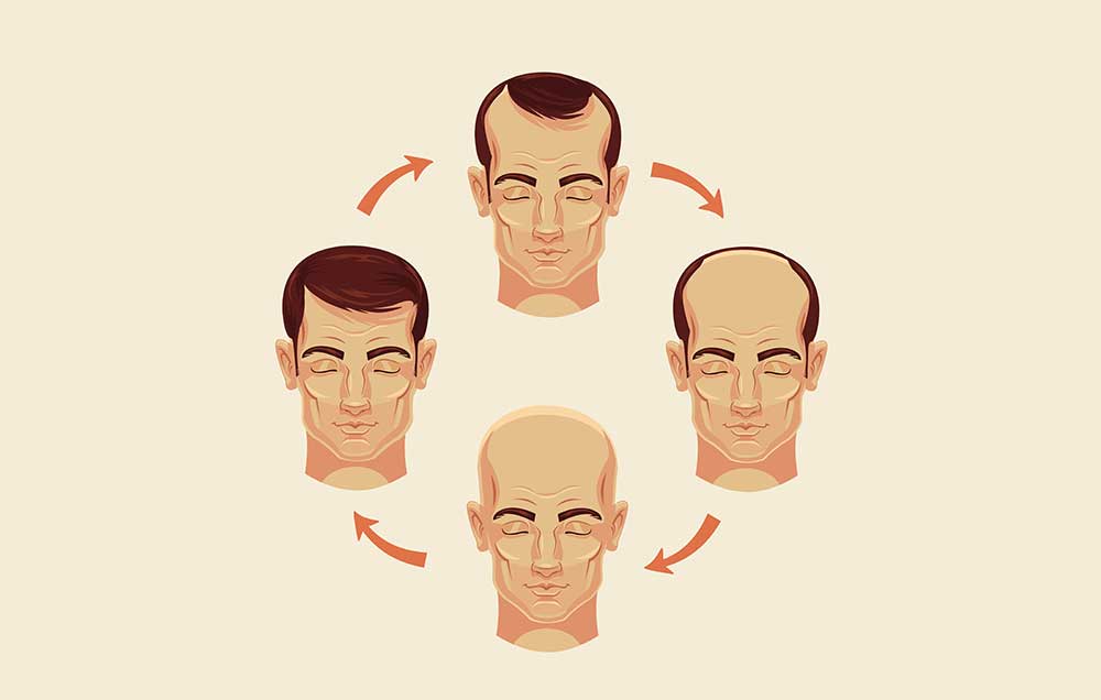 What You Need To Know About Hair Loss 