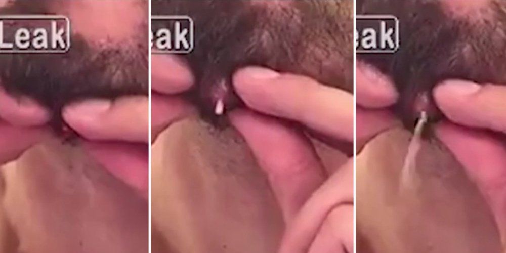Pimple Boy Porn - Man Pops a Giant Pimple On His Chin and Almost Vomits | Men's Health
