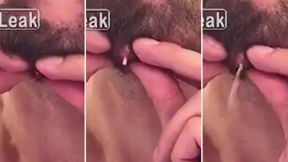 Pimple Pussy Porn - Man Pops a Giant Pimple On His Chin and Almost Vomits | Men's Health