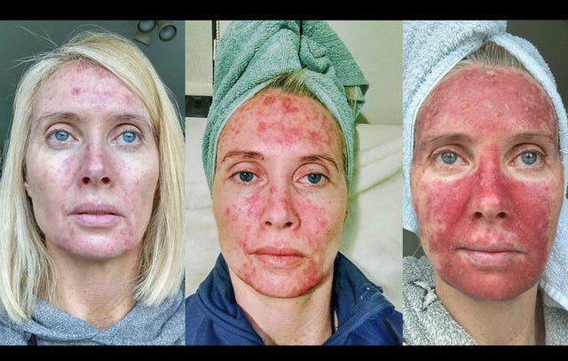 Woman’s Viral Photos Expose the Dangers Of Tanning | Men’s Health