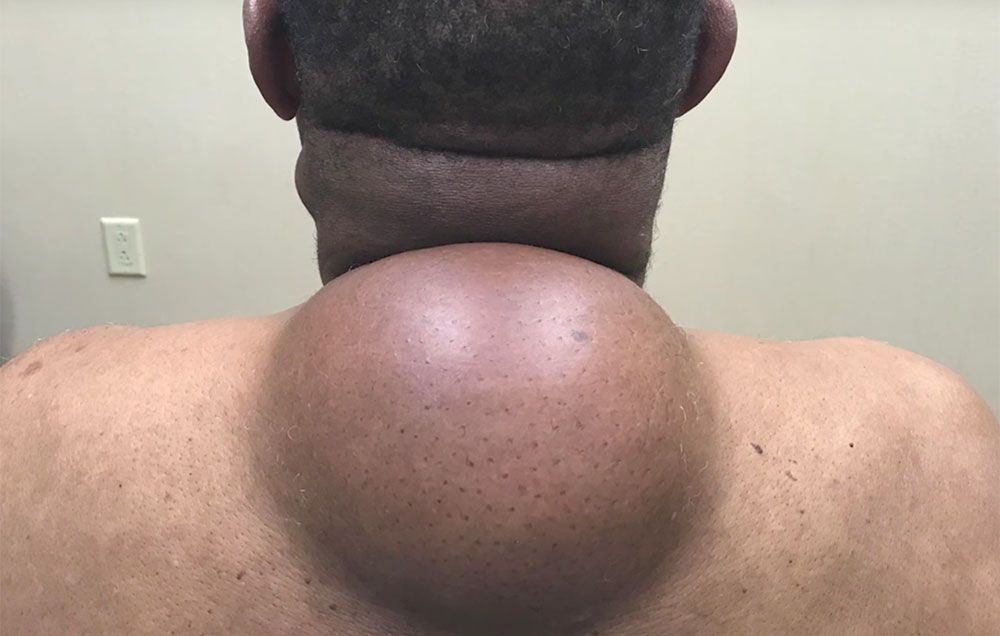dr pimple popper removes cyst