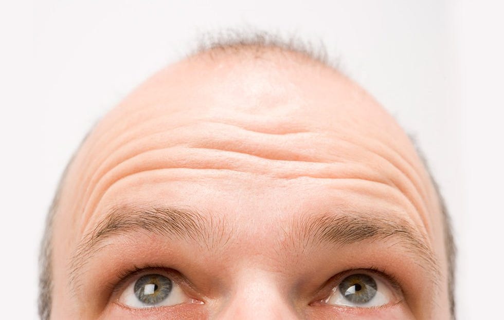 Hair Loss Cure - Osteoporosis Drug May Cure Balding, Study Finds Hair Loss Cure - Osteoporosis Drug May Cure Balding, Study Finds
