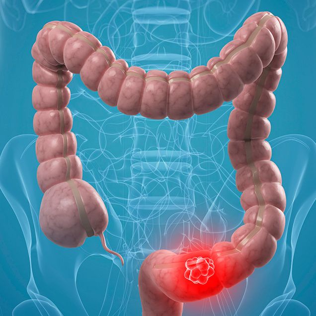 colon cancer screening soon than you think