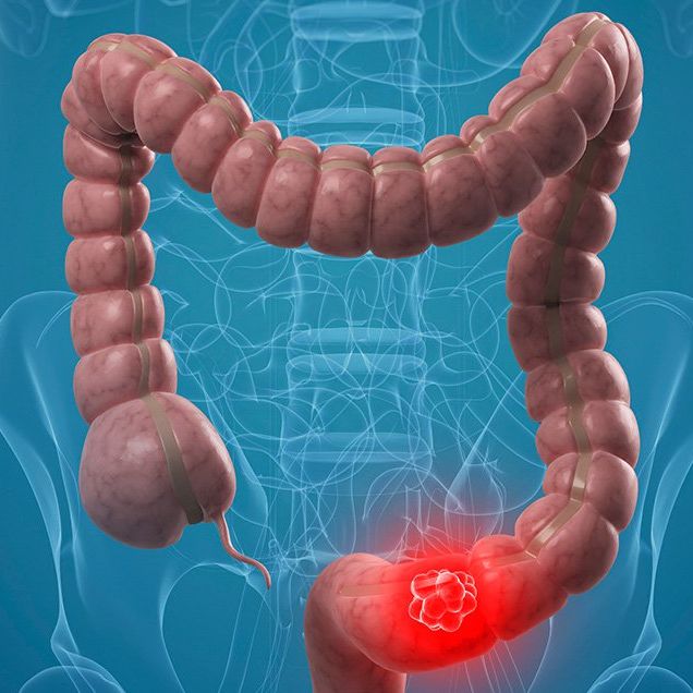 common food to fight colon cancer