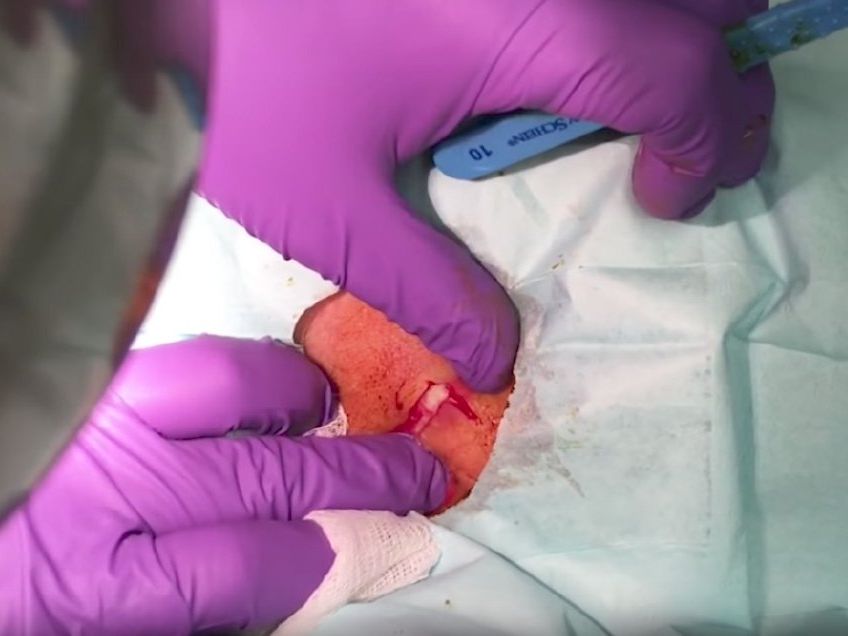 Watch This Giant Cyst Pop Like It Was Shot Out Cannon | Health