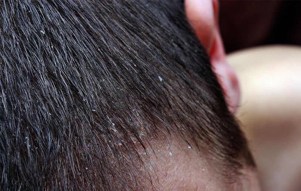 The Best Products to Get Dandruff-Free Hair​ | Men's Health