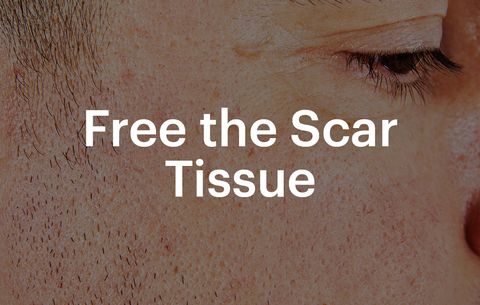 free scar tissue