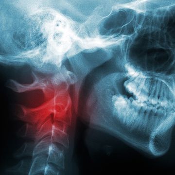 head/neck cancers on the rise
