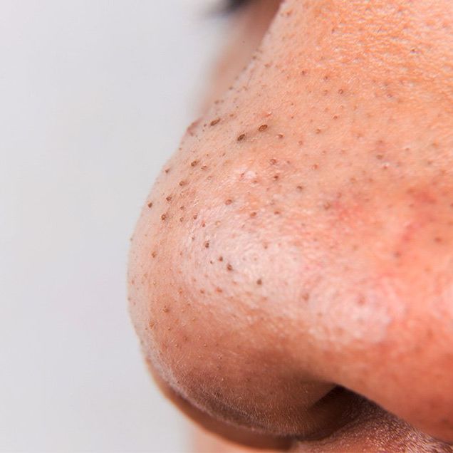 let someone squeeze blackheads