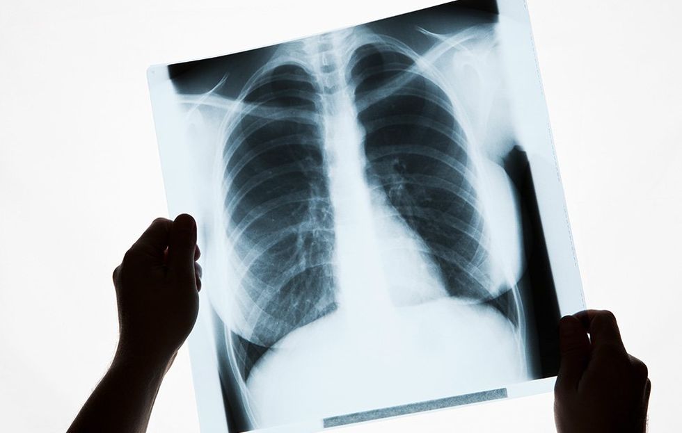 This Is Why Men Need to Be Screened For Lung Cancer More Than Women