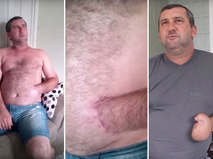 Man Has Mangled Hand Sewn Into His Stomach, Now Has “Mitten” Hand