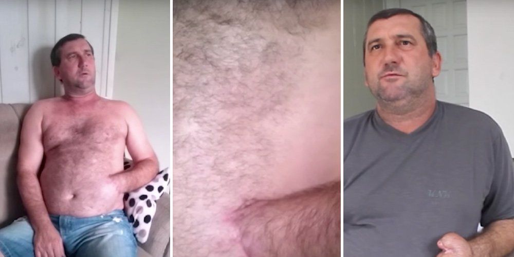 Man has hand sewn into his stomach to save it
