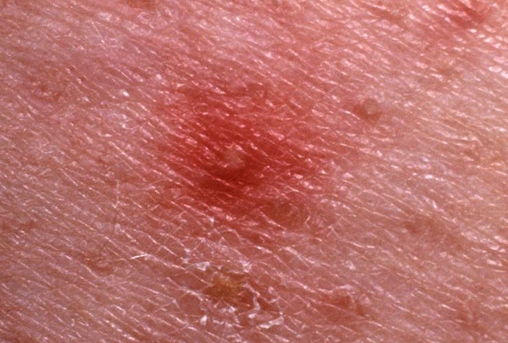 Sores and scabs on scalp Causes treatment and prevention