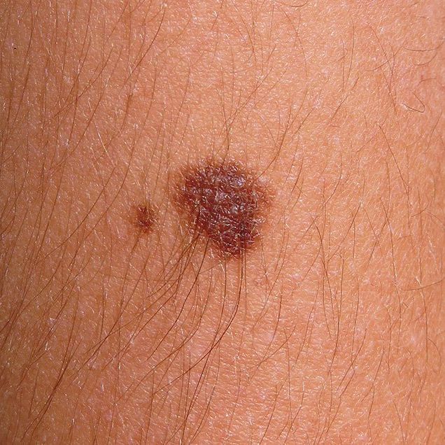 mole changes signs of melanoma