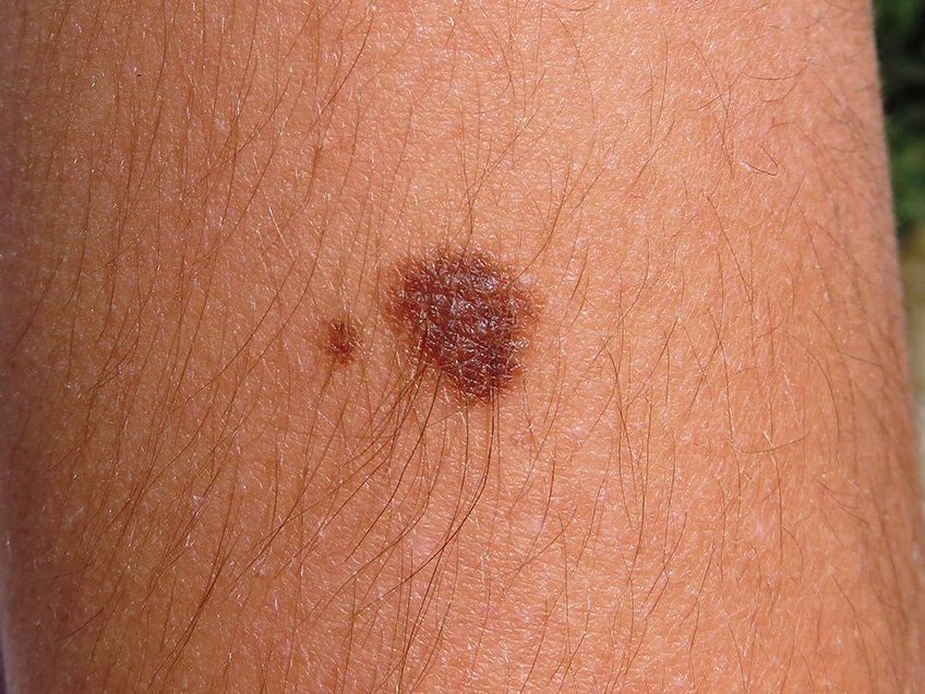redaktionelle nyhed Incubus Signs Of Melanoma| Men's Health