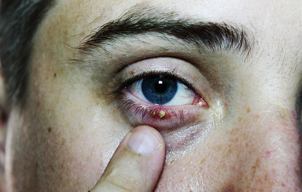 Eye - What Causes Eye Styes - Men's Health