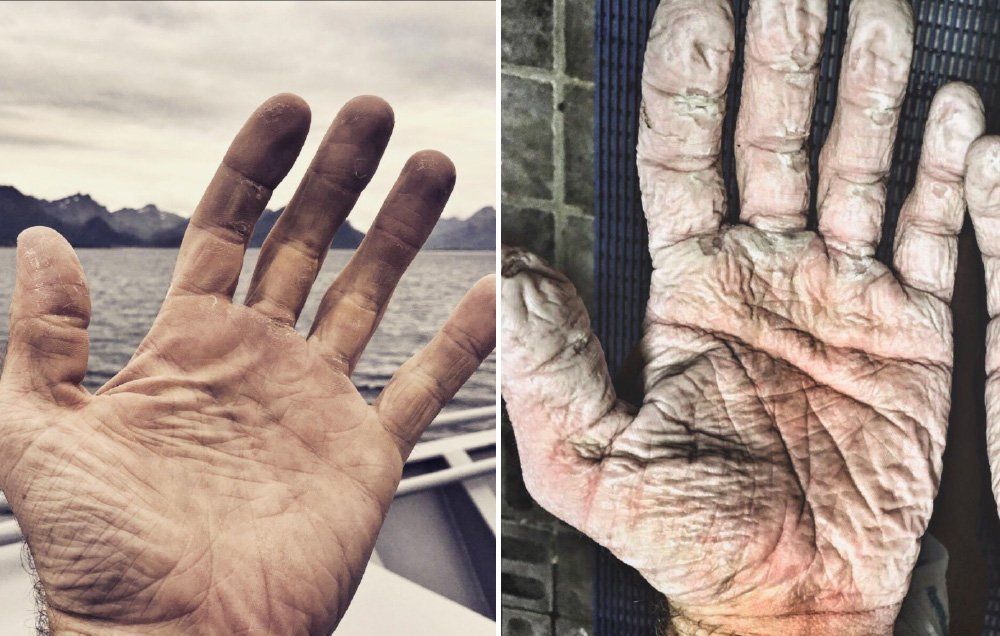 Olympic rower's hands after rowing 600 miles in Arctic 