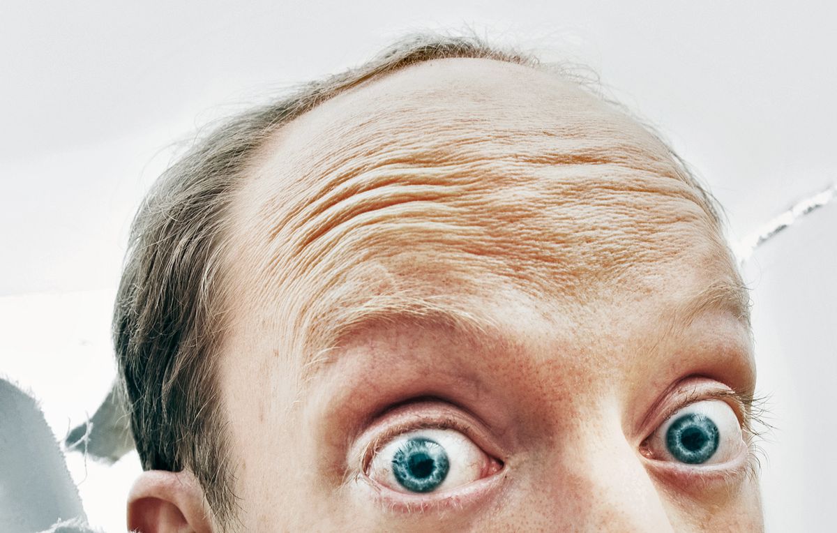balding may be sign of heart disease