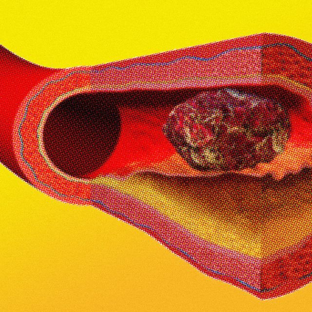 why blood clots are so deadly