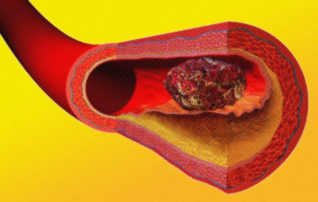 Blood clots: five reasons they may happen