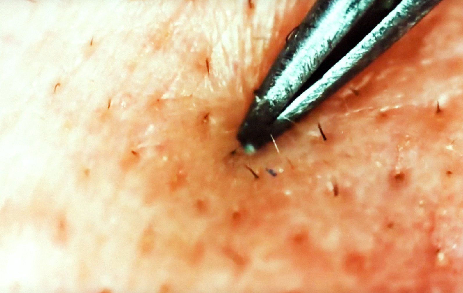 How Ingrown Hairs Are Removed  Art Insider  YouTube
