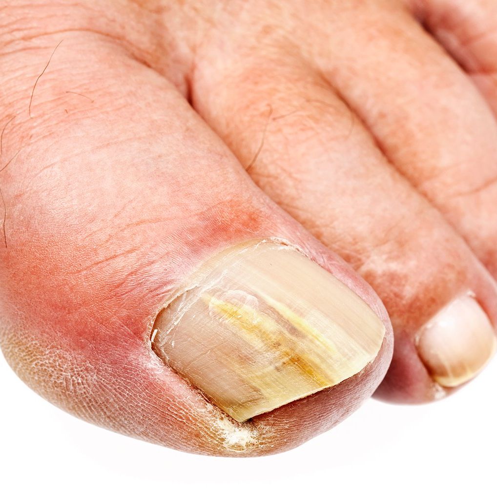 What Causes Toenail Fungus? How to Prevent Onychomycosis, or Crusty Yellow  Nails​ | Men's Health