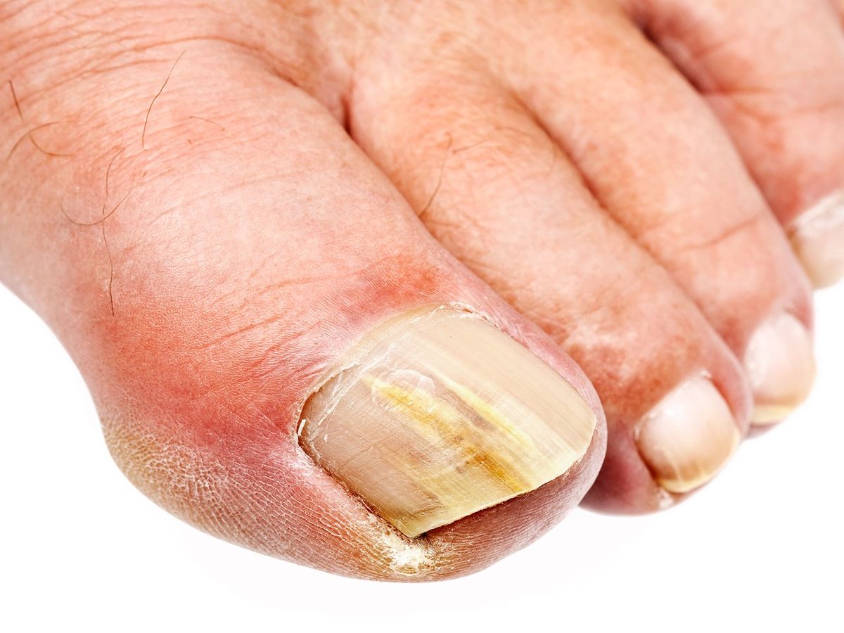 Thick nails, Nail problems, What We Treat