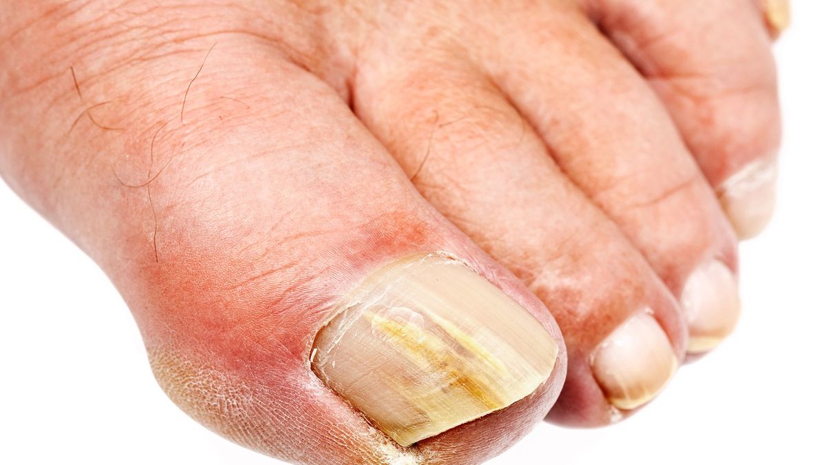 What Causes Toenail Fungus? How to Prevent Onychomycosis, or Crusty Yellow  Nails​