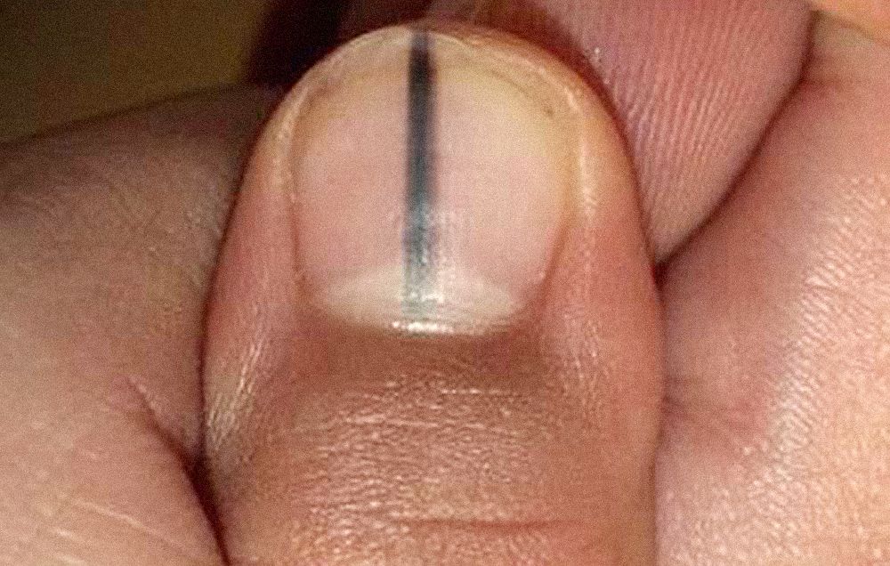 black line down fingernail