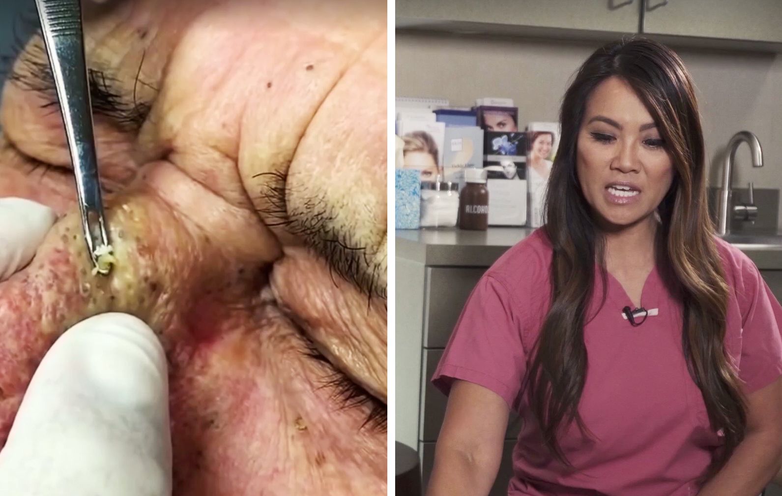skridtlængde montage gå We Talked to Dr. Pimple-Popper About Why Zit-Popping Videos Are So Damn  Popular | Men's Health