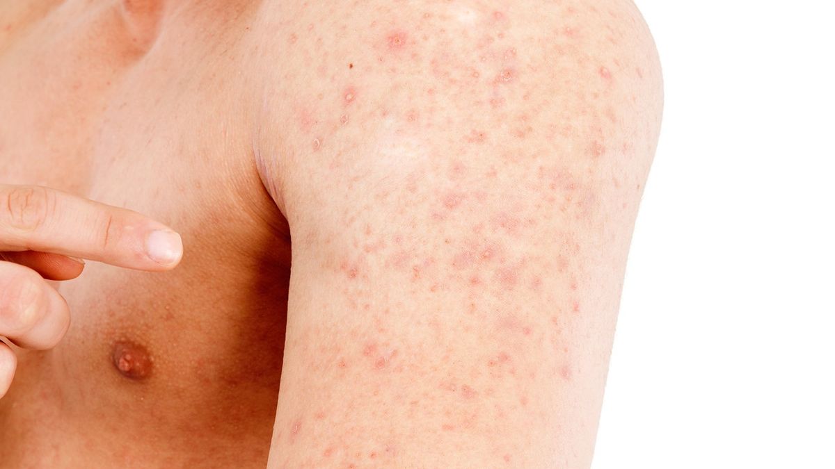 How to Know If You're Experiencing Heat Rash