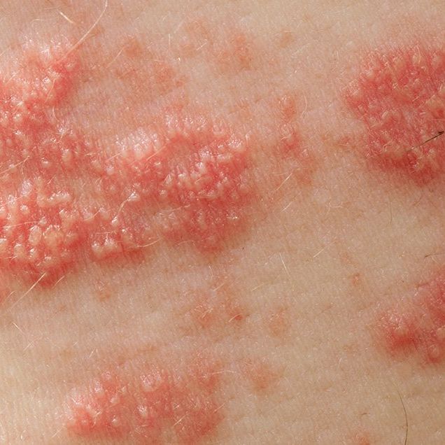 painful skin rash and shingles