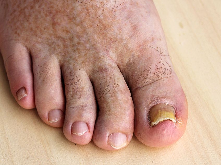 How to Fix Your Gross Feet​