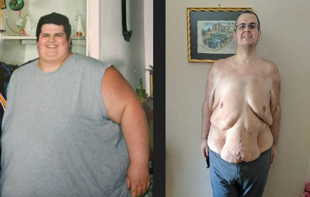 Man Bravely Shows Excess Skin after Naturally Losing 400 Pounds 