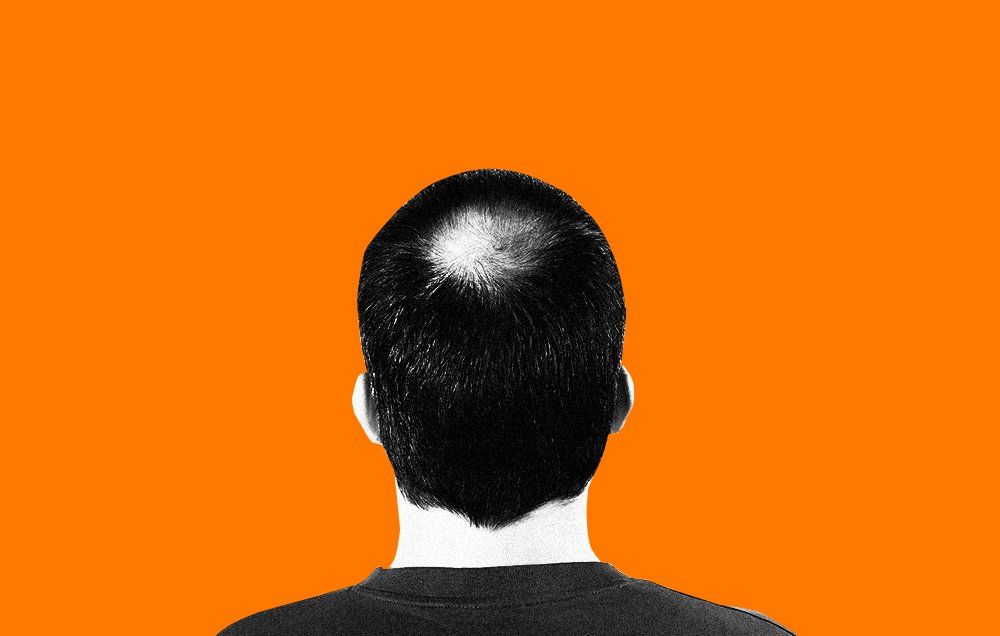 Dihydrotestosterone (DHT) Can Cause Baldness, But What Is It? | Men's Health