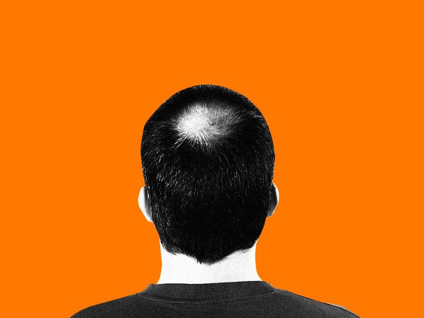 Dihydrotestosterone (DHT) Can Cause Baldness, But What Is It? | Men's Health