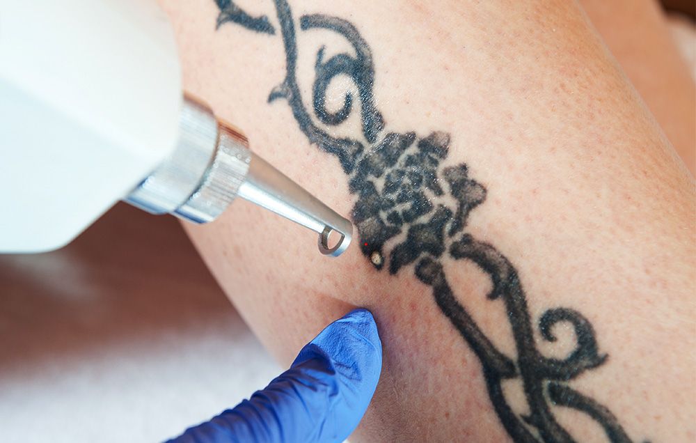 How to Remove Your Tattoo | Men's Health