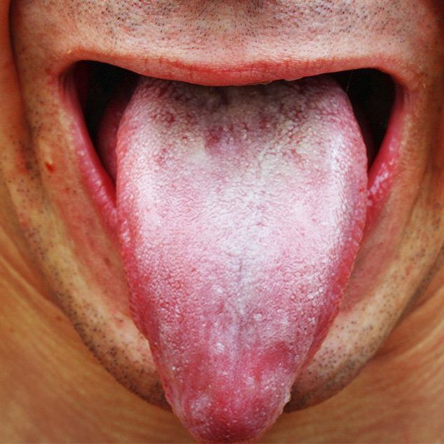 white film on tongue