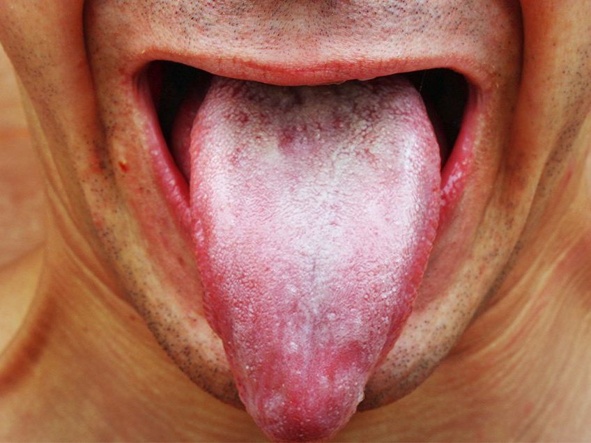 Kritik Kunde dør spejl White Tongue Causes: Should You Worry? | Men's Health