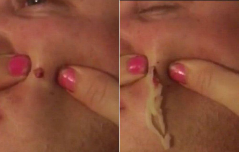 wife pops husband gross pimple