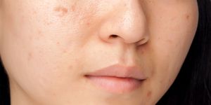 adult acne in women