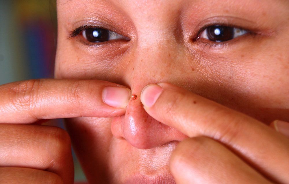 Sight of This Woman Squeezing Her Blackheads Is Both Disturbing Mesmerizing | Women's Health