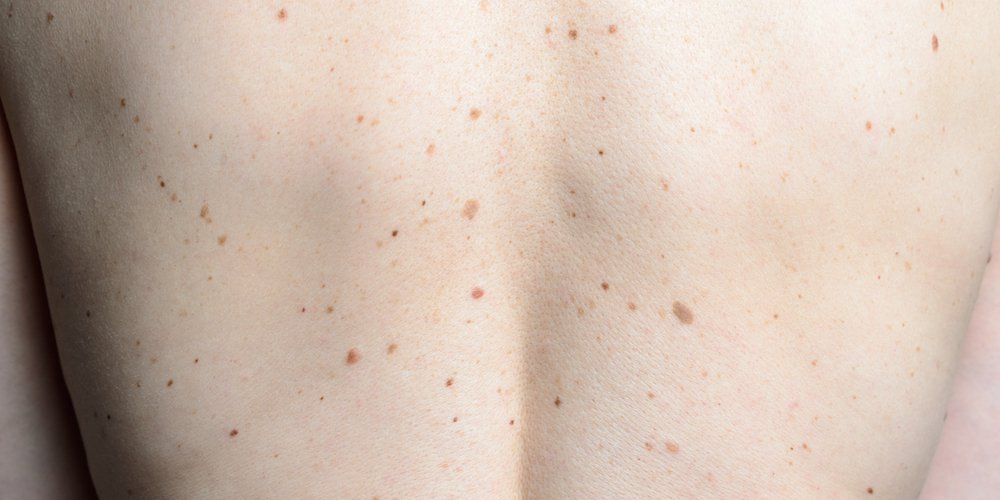 Why Did This Woman Develop Thousands of Moles All Over Her Body? | Women's Health