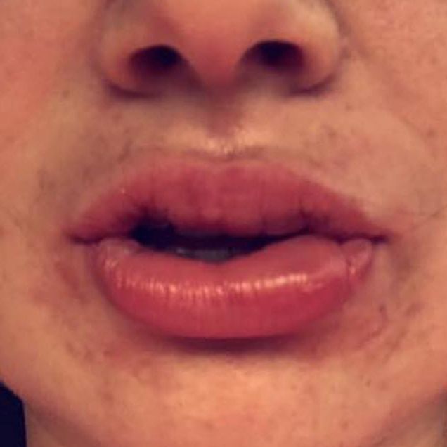 swollen lip from teeth whitening treatment